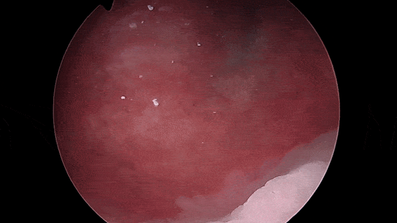 a video of bludigo dye being injected inside urinary system